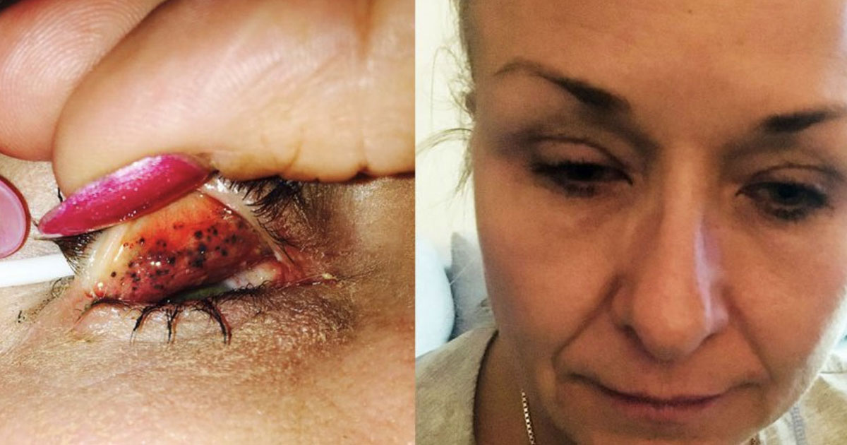 Mascara embedded in woman's eyelid