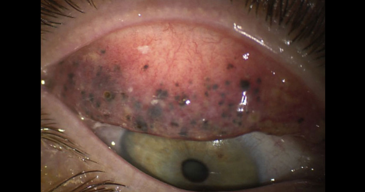 Subconjunctival Mascara Deposition