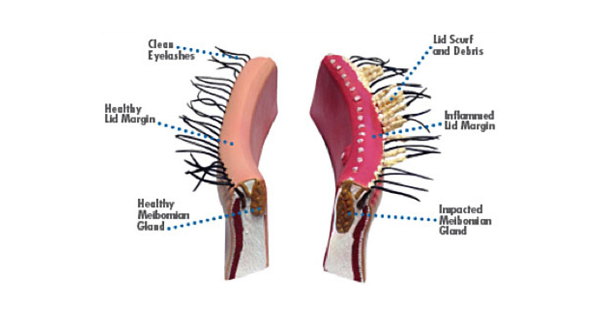 Blepharitis