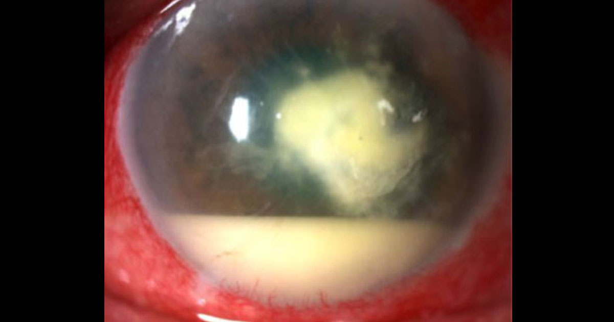 Microbial Keratitis (Corneal Abscess)