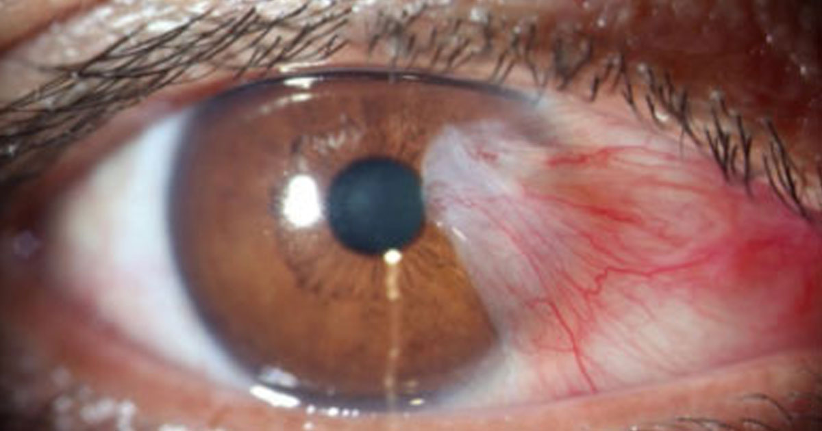 Pterygium