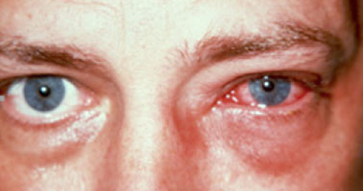 Viral Conjunctivitis