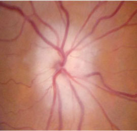 Pale swollen optic disc, due to optic nerve infarction