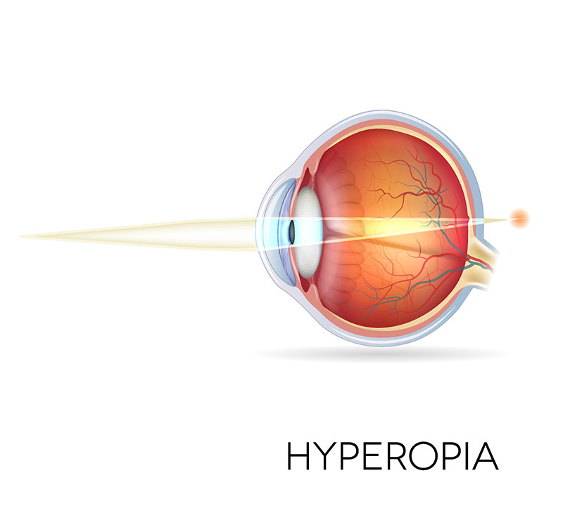 long-sightedness-treatment-at-forest-eye-surgery